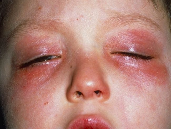 Аллергия на холод у ребенка на лице фото