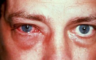 Воспаление глаза у взрослых и детей