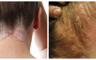 Экзема волосистой части головы – что вызывает дерматоз, как распознать и лечить болезнь?