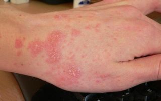 Аллергия на духи: симптомы, проявления, лечение