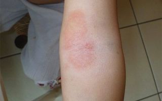 Аллергия на хозяйственное мыло