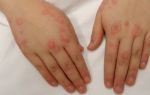 Аллергия на холод: все, что нужно знать о симптомах, причинах и лечении болезни