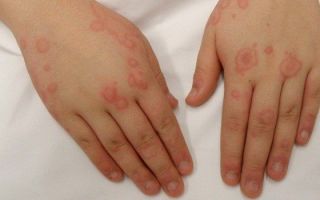 Аллергия на холод: все, что нужно знать о симптомах, причинах и лечении болезни