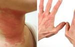 Токсико-аллергический дерматит кожи
