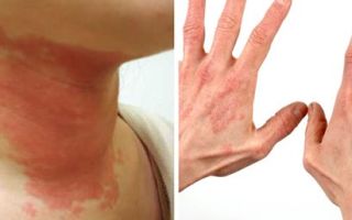 Токсико-аллергический дерматит кожи