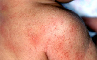 Аллергия у людей