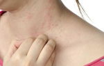 Аллергия на моль: причины, симптомы, предупреждение заболеваний
