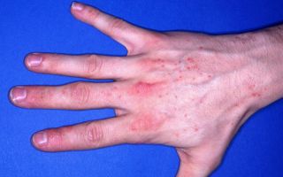 Аллергический контактный дерматит