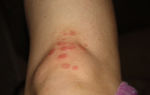 Аллергия на коленях