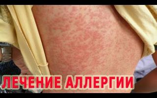 Лечение аллергии (народное и медикаментозное)