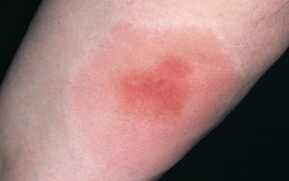 Аллергия на шершни: как предотвратить болезнь, способы лечения
