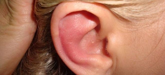Аллергия на ухе, на ушах – что делать ребенку и взрослому