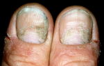 Экзема на ногтях рук – клинические проявления, диагностика, лечение
