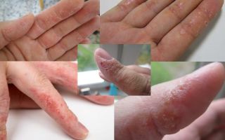 Экзема на пальцах рук – причины болезни и эффективные способы ее лечения