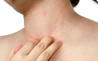 Аллергия на салицилаты: почему появляется, симптомы.
