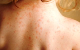 Аллергия – сыпь по всему телу
