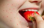 Аллергические реакции на фрукты