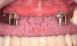 Аллергия на зубные коронки