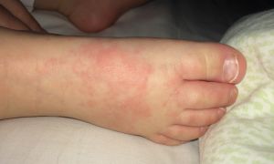 Аллергия на ступнях ног у ребенка, у взрослого