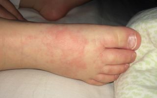 Аллергия на ступнях ног у ребенка, у взрослого