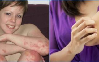 Аллергия на лак: причины, симптомы, места локализации. методы лечения, препараты