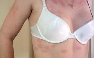Аллергия на белье
