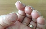 Аллергия на ногтях