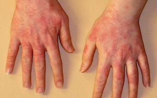 Аллергия на мороз: причины, симптоматика, особенности