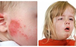 Аллергическая реакция на рис в младенческом возрасте
