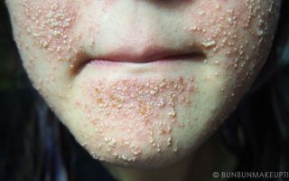 Аллергия на маску для лица