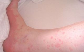 Аллергия на холод на ногах: симптоматика и терапия