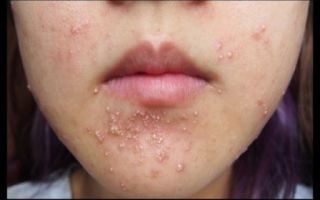 Аллергия на миндаль