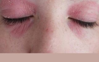 Аллергия на косметику