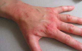 Аллергическая экзема: причины, симптомы, как лечить