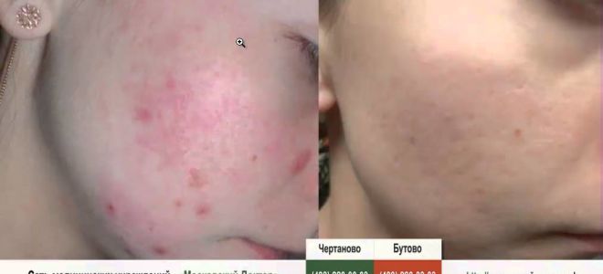 Аллергия на порошок и гель «бадяга»
