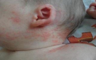 Аллергия на шее у ребенка и взрослого