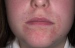 Экзема на лице – особенности и разновидности заболевания, как проявляется, варианты лечения