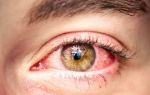 Аллергическое нарушение зрения