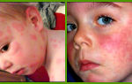 Аллергия на тюльпаны у взрослых и детей