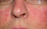 Аллергия на щеках у ребенка, у взрослого