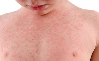 Сезонная аллергия у взрослых