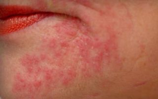 Что такое аллергический дерматит и как с ним бороться