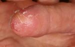 Экзема на пальцах ног – как вылечить дерматоз и устранить симптомы?