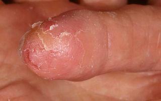 Экзема на пальцах ног – как вылечить дерматоз и устранить симптомы?