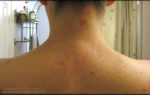 Аллергия на плечах