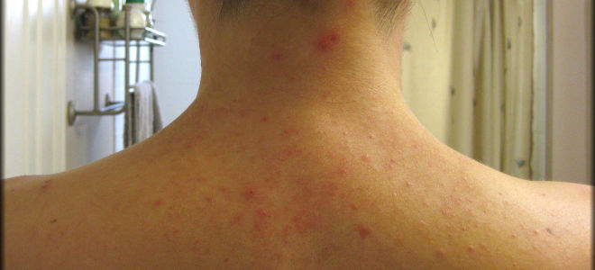 Аллергия на плечах