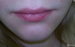 Аллергический хейлит губ