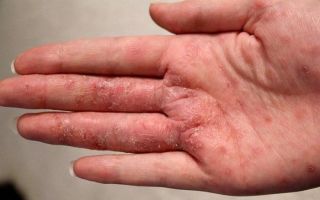 Пузырьки при экземе: причины, разновидности болезни, как вылечить кожу
