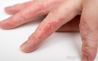 Аллергия пальцев рук