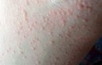 Аллергия на блох у человека